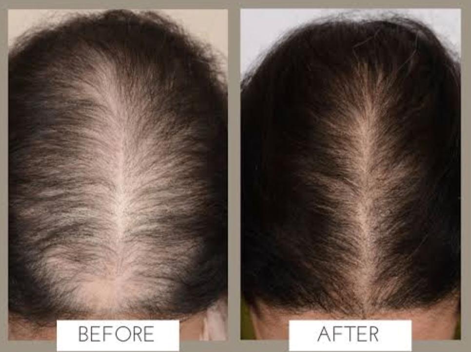 GFC Hair PRP Treatment