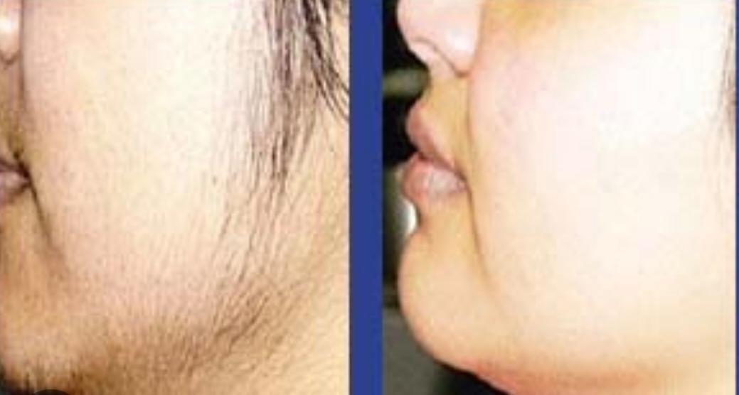 Laser Hair Reduction