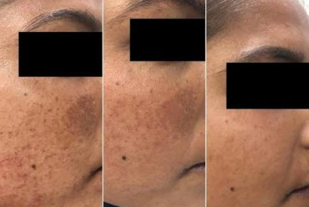 Melasma Treatment