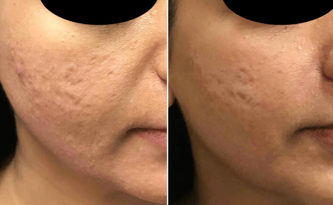 Microneedling RF Tightening