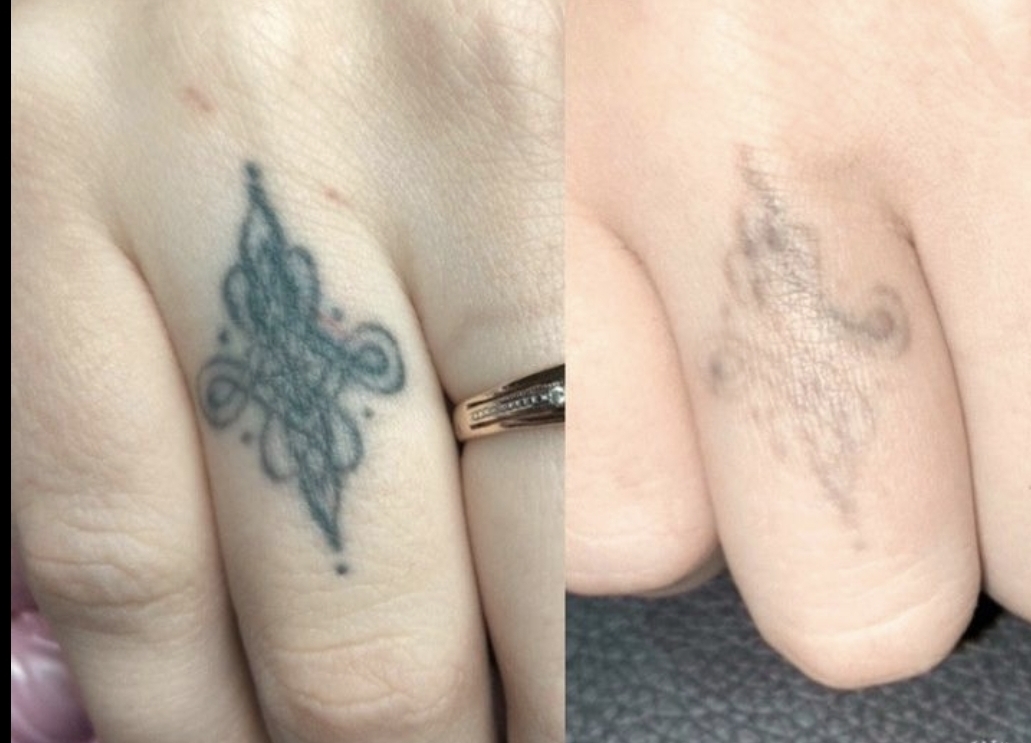 Tattoo Removal